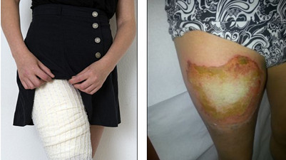 انفجار هاتف سامسونغ في جيب فتاة ( صور )